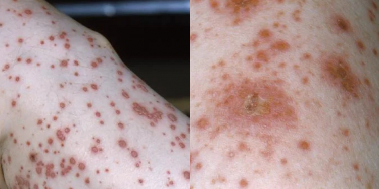 번콤 카운티, 수두·백일해 동시 확산…학교 중심 감염 증가