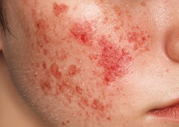 홍역, 사우스 캐롤라이나에 이어 조지아도 뚫렸다.