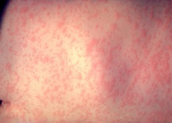 사우스캐롤라이나, 홍역 확산…최근 15명 추가 확진, 학교 11곳 영향