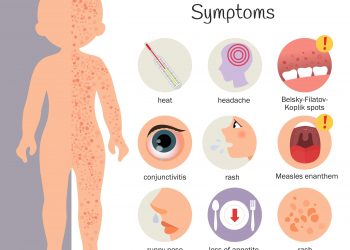 사우스캐롤라이나발 홍역, 노스캐롤라이나 번컴까지 확산… 세 남매 확진