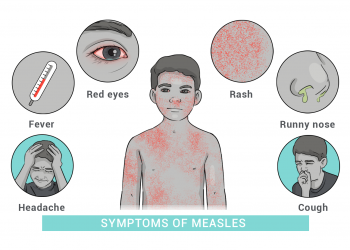 “역대 최악 수준” 미국 홍역 대유행