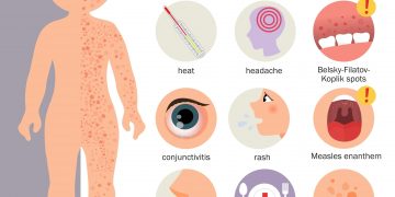 사우스캐롤라이나발 홍역, 노스캐롤라이나 번컴까지 확산… 세 남매 확진