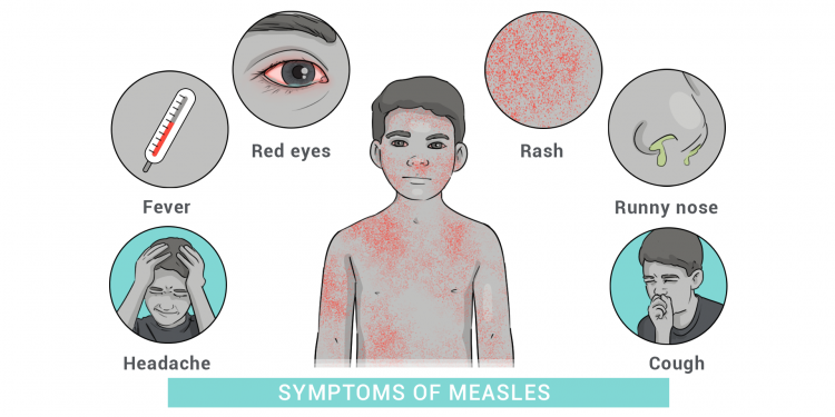 “역대 최악 수준” 미국 홍역 대유행
