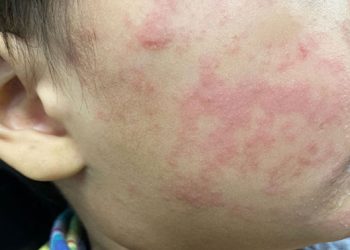 홍역 확산: 노스캐롤라이나 확진 9건으로 증가