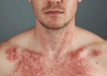 개스톤 카운티 홍역 비상… 노스캐롤라이나 역내 세 번째 확진 사례