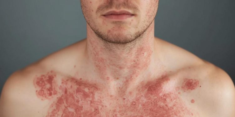 개스톤 카운티 홍역 비상… 노스캐롤라이나 역내 세 번째 확진 사례