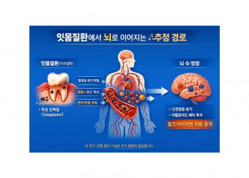 “잇몸질환, 알츠하이머 위험의 새로운 연결 고리 — 과학계 주목”