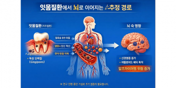 “잇몸질환, 알츠하이머 위험의 새로운 연결 고리 — 과학계 주목”