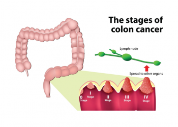 대장암, 50세 미만 사망률 1위로 급부상