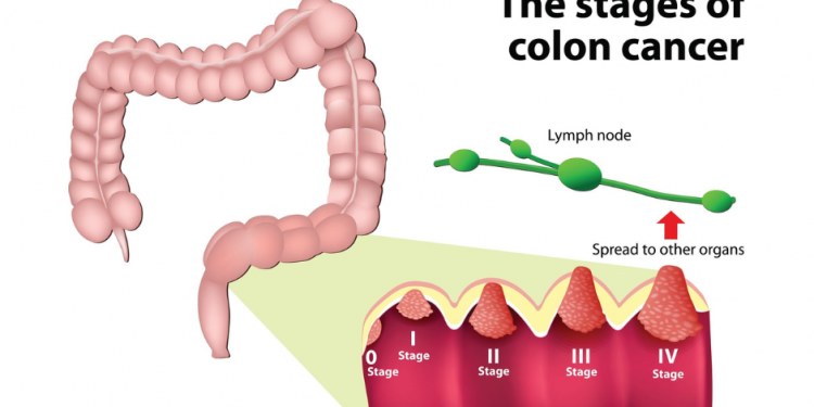 대장암, 50세 미만 사망률 1위로 급부상