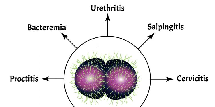 켄트발 ‘B형 수막염’ 유럽 상륙… ‘슈퍼 전파’에 보건당국 비상