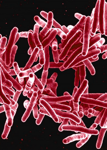 ‘하얀 역병’ 결핵의 귀환… 미 전역 비상, 10년 만에 최고치 기록